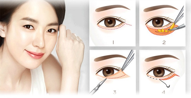 Cần chọn trung tâm thẩm mỹ có tên tuổi, uy tín để cắt bọng mỡ mắt