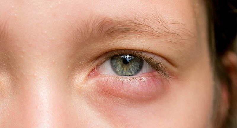 Lấy bọng mỡ mắt cần có sự chuẩn bị tốt về mặt tâm lý