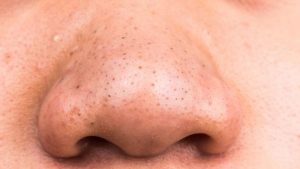 Sự bài tiết dầu quá mức của da khiến lỗ chân lông to và dễ sinh ra mụn