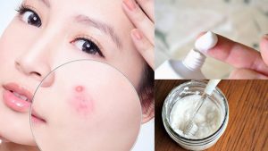 Kem đánh răng bôi lên nốt mụn đỏ có thể giảm ngay triệu chứng sưng đauKem đánh răng bôi lên nốt mụn đỏ có thể giảm ngay triệu chứng sưng đau