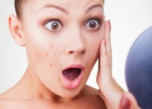 Mụn trứng cá gây cho da kém thẩm mỹ hơn