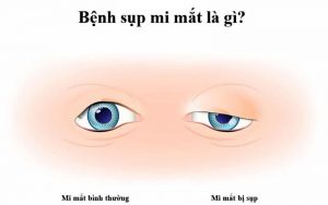 Sụp mí mắt có biểu hiện phần mi sa trễ gây cản trở tầm nhìn