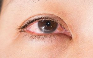 Mí mắt bị sưng vào những ngày đầu sau khi nhấn mí