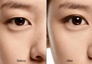 Nhấn mí mắt giúp bạn sở hữu 2 mí mắt to tròn, cuốn hút, tự nhiên