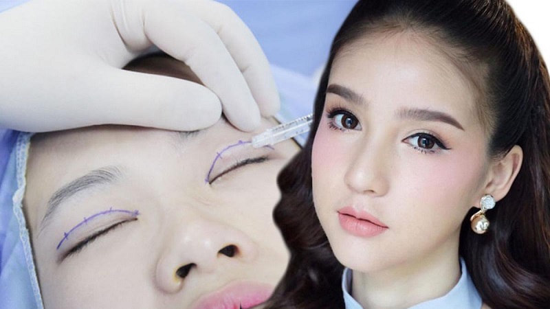 Nhấn mí mắt được thực hiện nhanh chóng nhưng đòi hỏi bác sĩ tay nghề cao