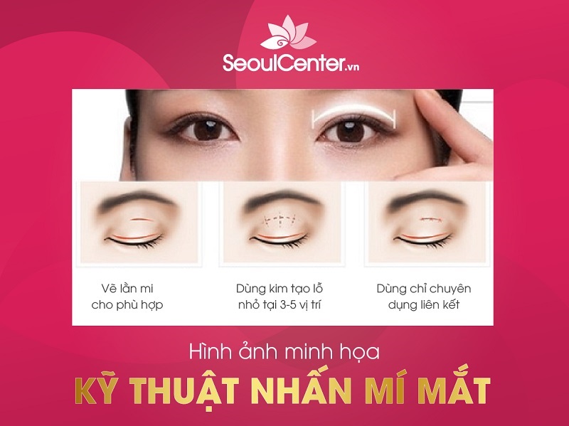 Nhấn mí là phương pháp làm đẹp không phẫu thuật được nhiều người ưa thích