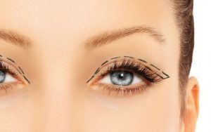 Nhấn mí mắt là kỹ thuật làm đẹp có giá “mềm” nhất