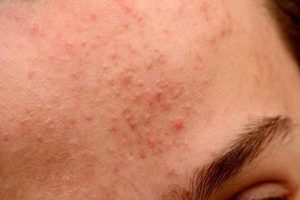 Mụn ẩn nếu không điều trị sẽ phát triển thành thể mụn nặng hơn