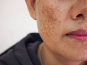 Nám da rất dễ xuất hiện trên mặt và ảnh hưởng nhiều đến thẩm mỹ