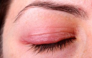 Mắt sưng húp, nỗi lo của các cô nàng