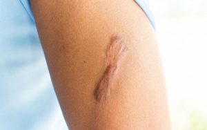 Sẹo thâm ở chân gây mất thẩm mỹ