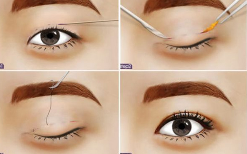 Những tác động ở vùng da mí khiến mí mắt sưng nề
