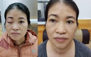 Giá phẫu thuật sụp mí mắt phụ thuộc vào mức độ sụp mí