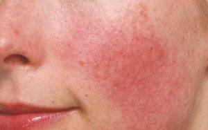 Hình ảnh một làn da mặt bị mỏng, nhạy cảm và dễ ửng đỏ
