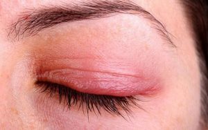 Uốn mi có thể khiến mi rụng nhiều, đỏ mắt và ảnh hưởng đến thị giác
