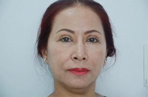  Cắt mí mắt bị trợn phải làm sao để khắc phục?