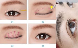 Cắt mí mini deep 6D mang nhiều ưu điểm khác biệt