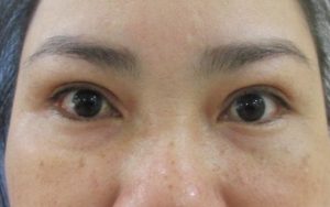 Mí mắt chứa túi mỡ gây sụp mí