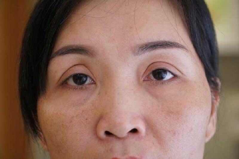 Hai mí không đều khiến khuôn mặt bất cân xứng