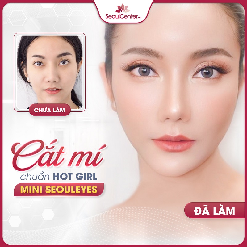 Seoul Center là một trong những địa chỉ cắt mí mắt uy tín bậc nhất Sài Gòn