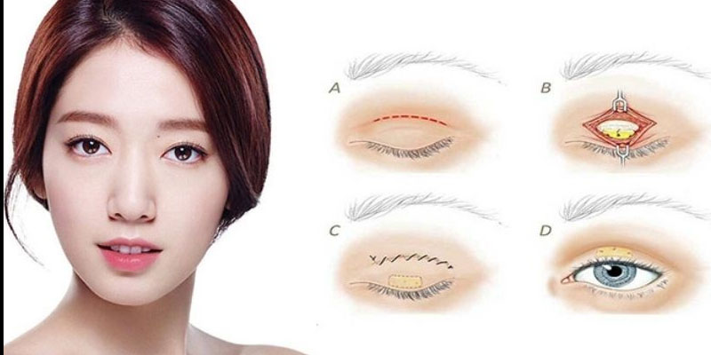 Cắt mí bao lâu hết sưng và đẹp tự nhiên