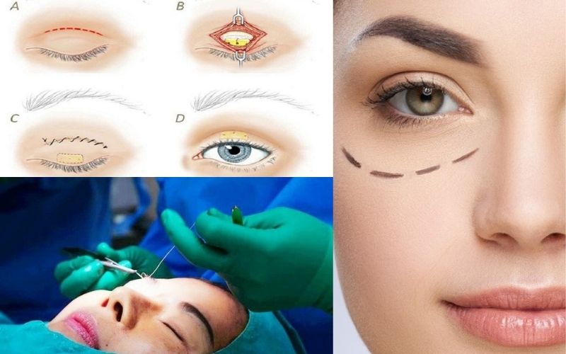 Cắt mí mắt bằng công nghệ hiện đại hạn chế xâm lấn, không để lại sẹo
