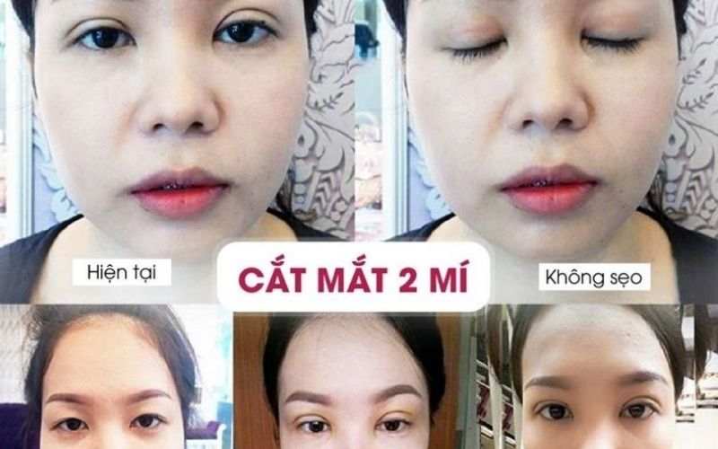 Khách hàng cắt mí thành công tại Seoul Center, không có bất kỳ sẹo xấu nào