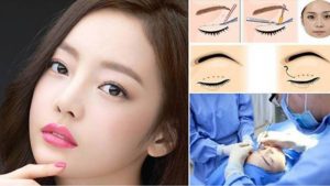 Phương pháp cắt mí có được vĩnh viễn không?