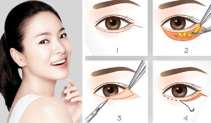 Cắt mí mắt dưới giá bao nhiêu và nên thực hiện ở đâu? - cắt mí mắt dưới giá bao nhiêu