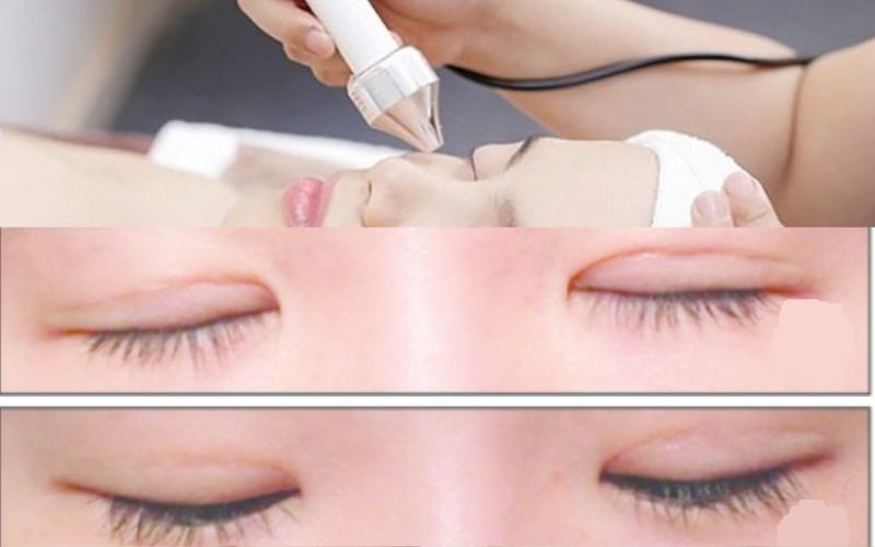 Sẹo mờ dần sau khi trị bằng laser