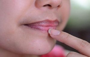 Thâm môi khiến nhiều chị em tự ti