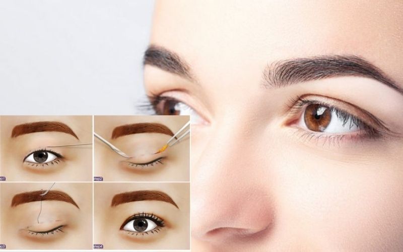 Cắt mí mắt trên tạo ra đường nếp mí mới to rõ