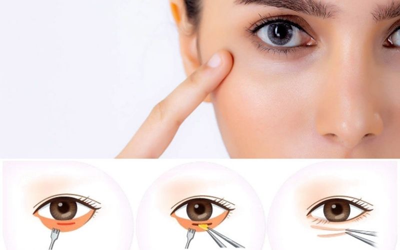 Cắt mí mắt dưới giúp đôi mắt to tròn hơn