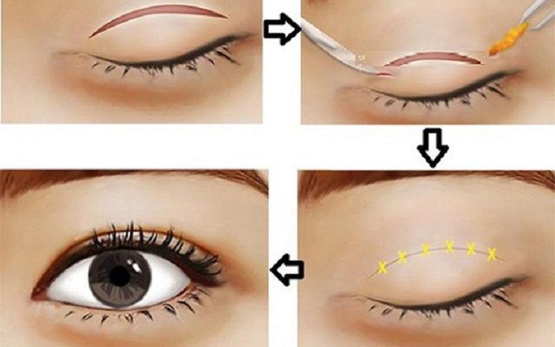 Cắt mí mắt thực hiện an toàn, ít xâm lấn