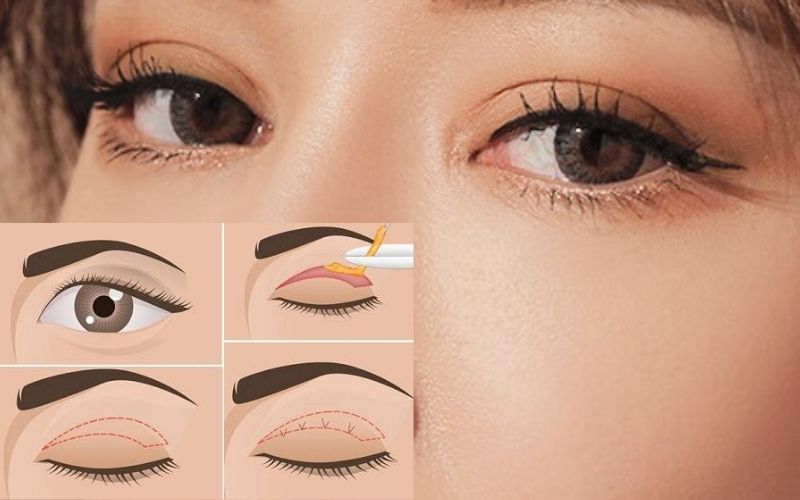 Cắt mí mắt Hàn Quốc tạo ra đôi mắt 2 mí to tròn tự nhiên