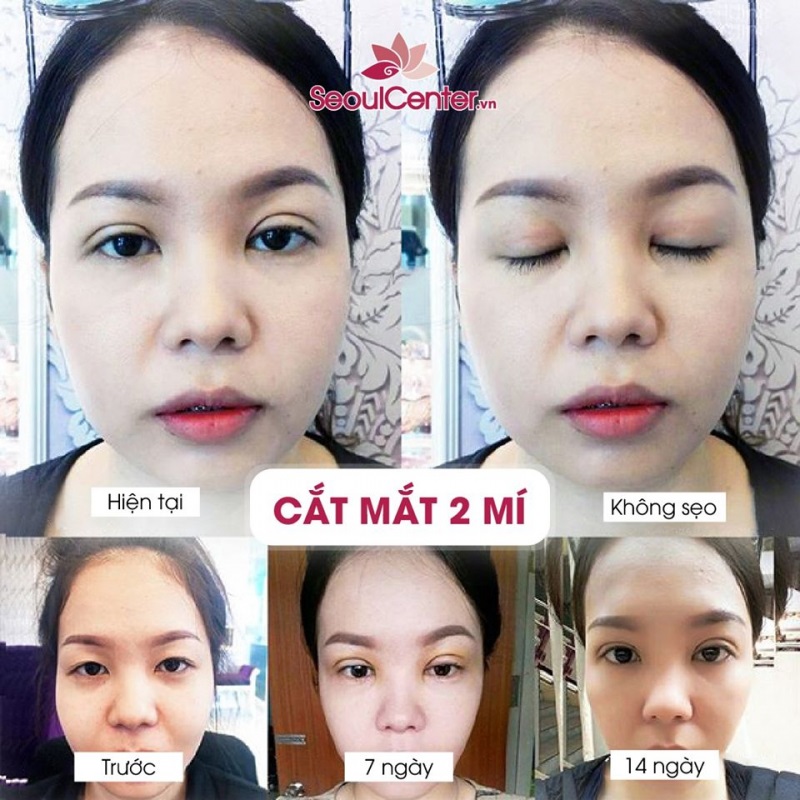 Cắt mí mang đến một đôi mắt hai mí tự nhiên