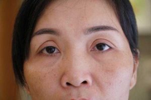 Sửa mí mắt bị cắt hỏng thực hiện như thế nào?