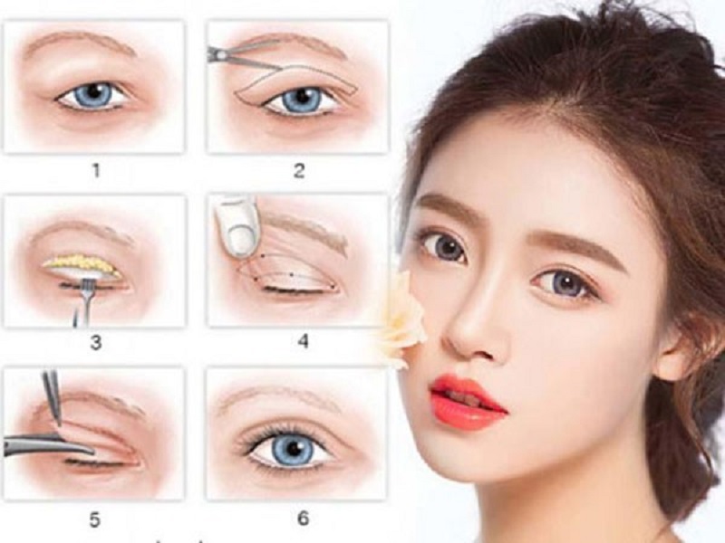Tùy theo cơ địa và công nghệ làm đẹp mà sẽ biết được cắt mí mắt kiêng ăn bao lâu