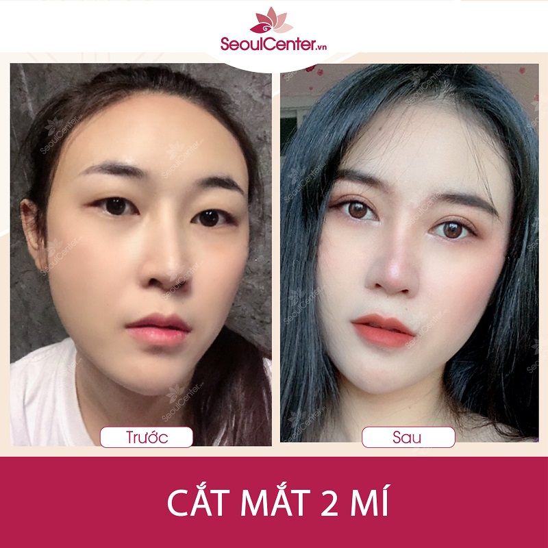 Hình ảnh khách hàng cắt mí mắt đẹp tại Seoul Center