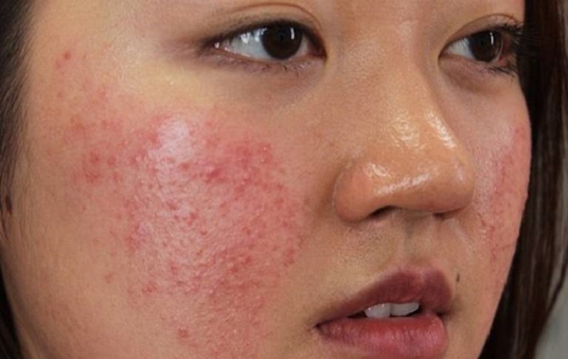 Da rất dễ kích ứng, nhạy cảm và mẩn đỏ sau sử dụng rượu thuốc