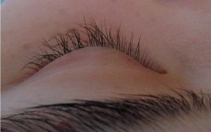 Duỗi mi uốn giúp khắc phục hậu quả thẩm mỹ