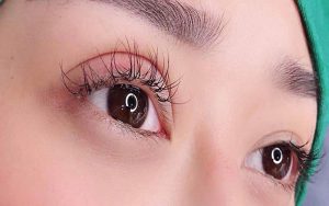 Sau quá trình cắt mí , mắt bị sưng, bầm tím là hết sức bình thường
