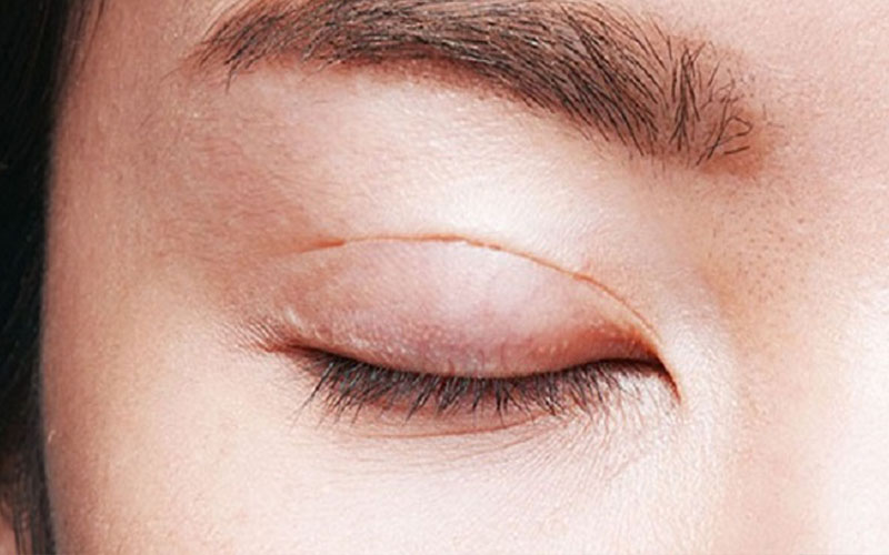 Những tác động vào vùng mí khiến mô mạch, cơ, da chịu tổn thương
