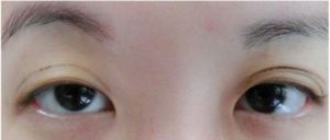 Cắt mí mắt bị hư chính là nỗi lo và ám ảnh của nhiều người