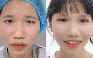 Cắt mí là giải pháp làm đẹp được nhiều chị, em tin tưởng ngày nay