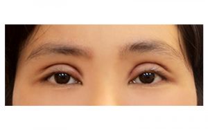 Mí mắt sưng không đều sau cắt mí là tình trạng phổ biến