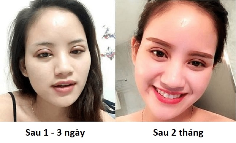 Cắt mí sẽ đẹp và tự nhiên sau 1 - 2 tháng