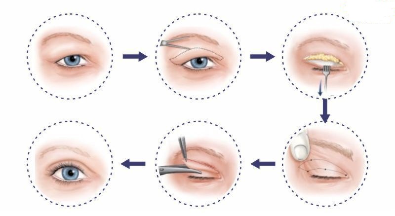Kỹ thuật cắt mí mắt được áp dụng an toàn, ít xâm lấn
