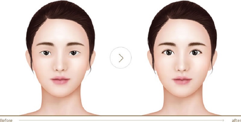 Phương pháp cắt mí mắt được thực hiện an toàn, ít xâm lấn