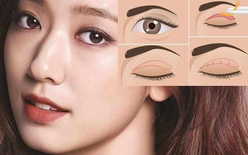 Chi phí cắt mí phụ thuộc vào nhiều yếu tố khác nhau